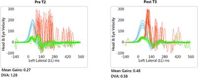 Exergaming With Integrated Head Turn Tasks Improves Compensatory Saccade Pattern in Some Patients With Chronic Peripheral Unilateral Vestibular Hypofunction